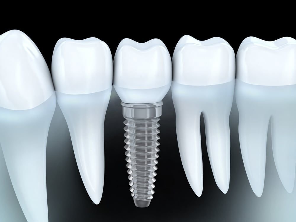 Invisalign vs. Σιδεράκια για παιδιά και εφήβους